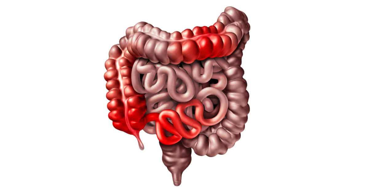 Ilustração da inflamação do tubo digestivo na Doença de Crohn