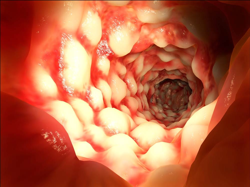 Paciente com sintomas de dor abdominal e diarreia persistente sugestivos de Doença de Crohn
